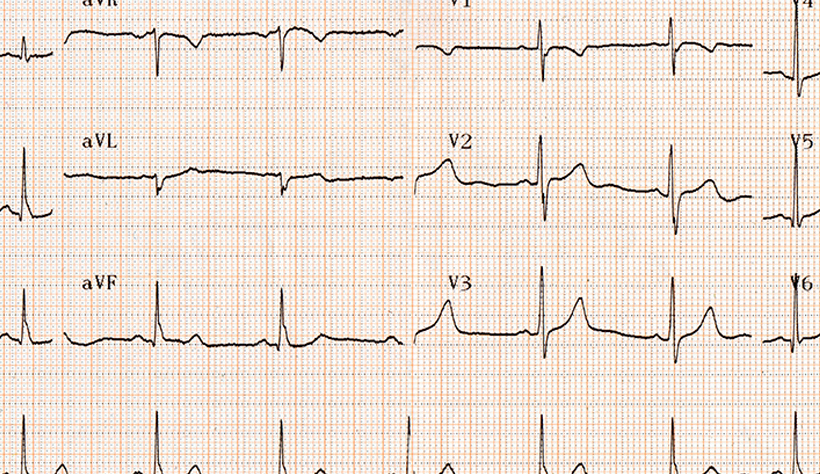 Traitement de la fibrillation atriale : le choc électrique , comment ça  marche ?